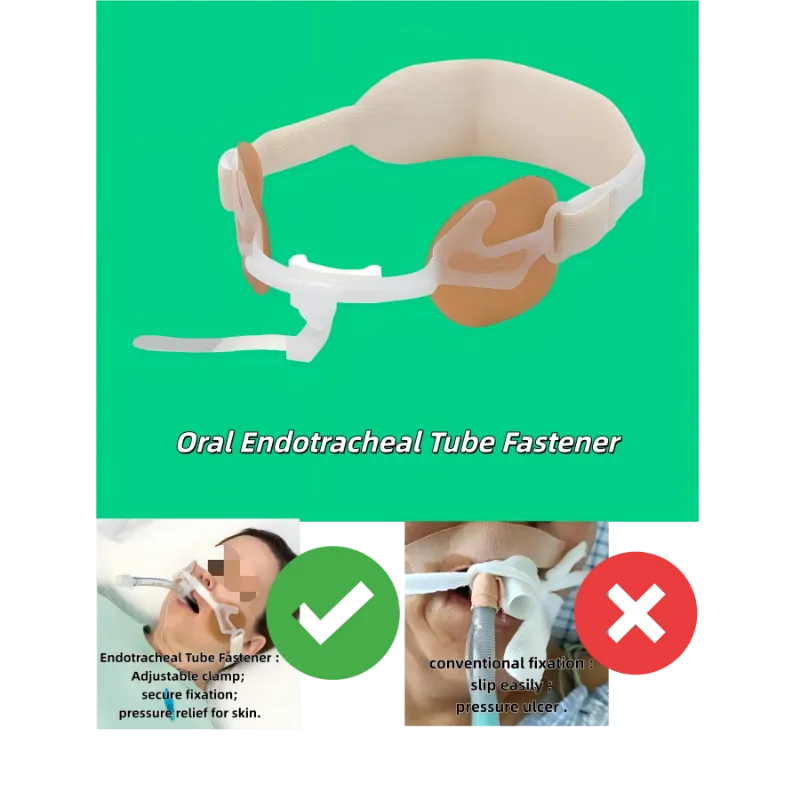 Dây buộc ống nội khí quản